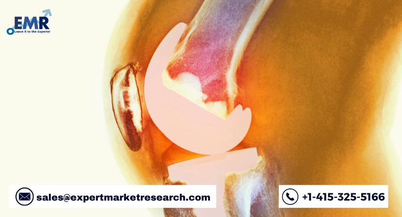 Global Cementless Total Knee Arthroplasty Market to be Driven by the Increasing Cases of Young Patients Seeking Knee Arthroplasty in the Forecast Period of 2022-2027